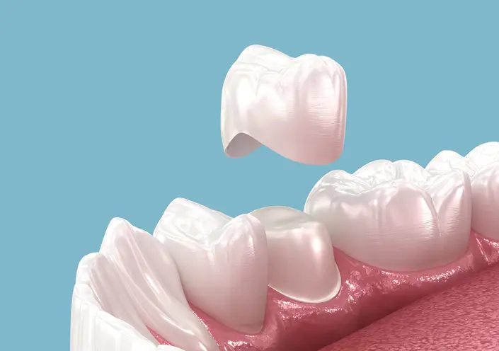 Dental crowns restoring a damaged tooth at Bell Road Dentistry