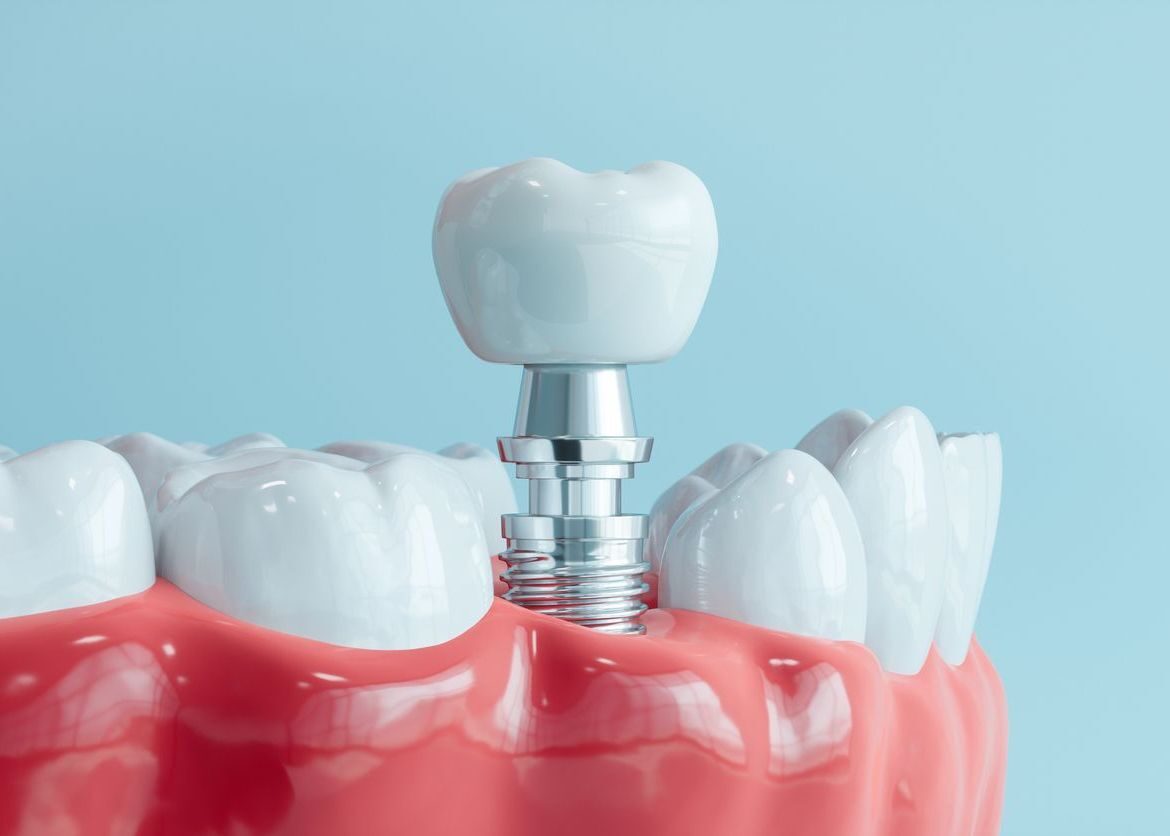 What is a Dental Implant