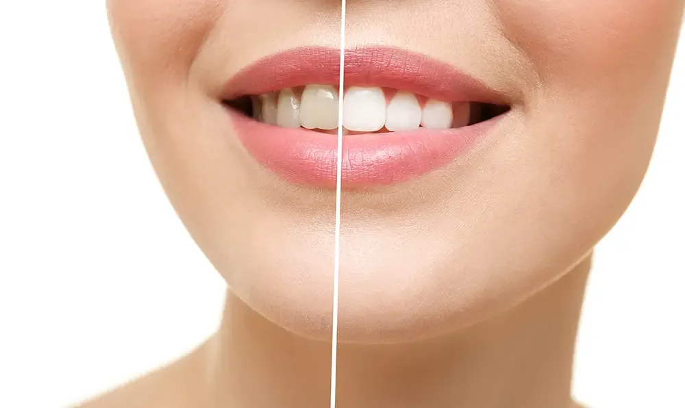 Teeth Whitening Treatment