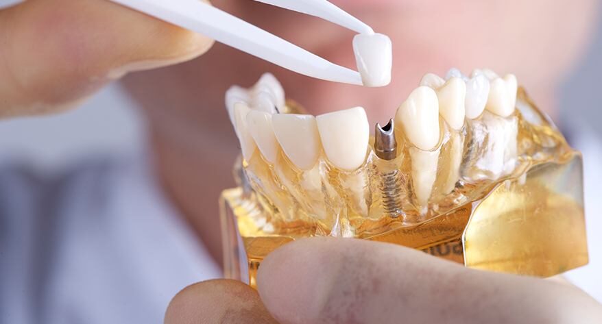 Dental Implants for Missing Teeth