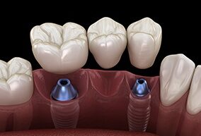 Full Arch Dental Implants
