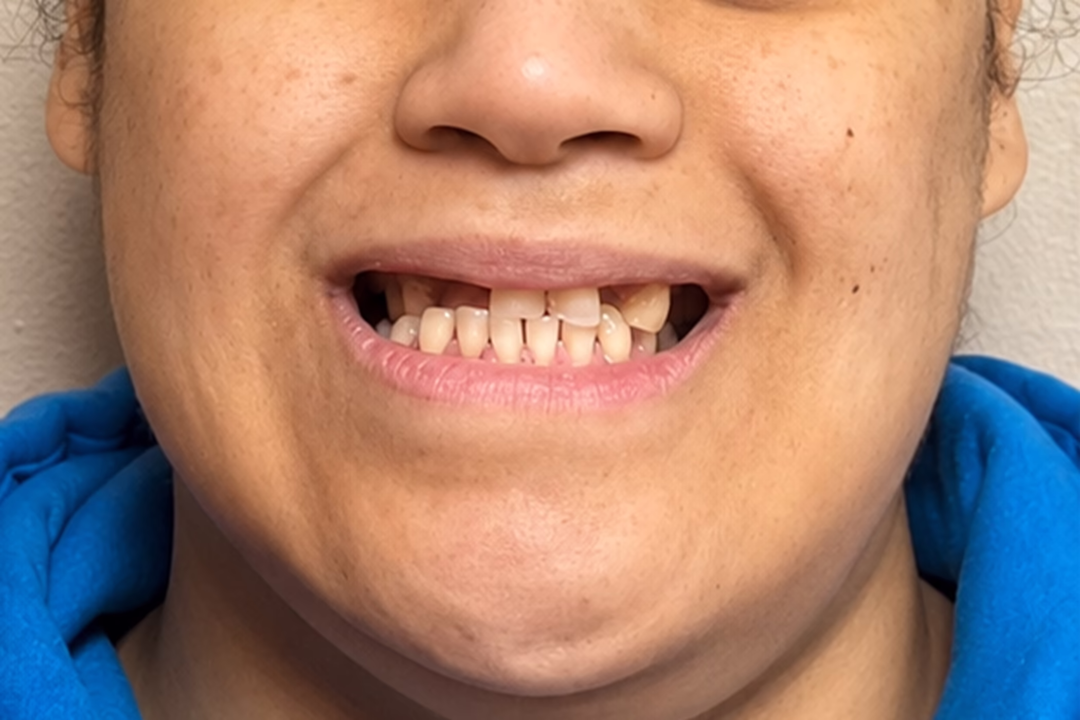Before cosmetic dentistry treatment at Bell Road Dentistry