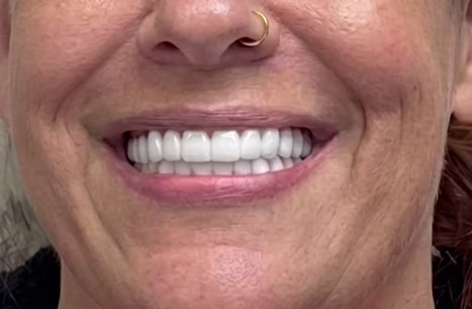Helen’s smile after treatment at Bell Road Dentistry