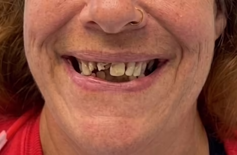 Helen’s smile before treatment at Bell Road Dentistry