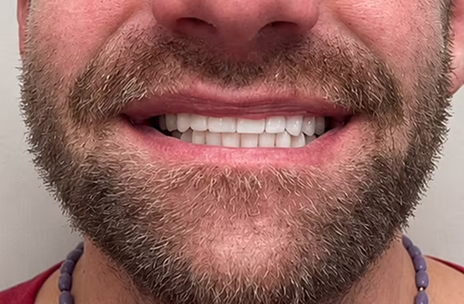 Ivan’s smile after treatment at Bell Road Dentistry