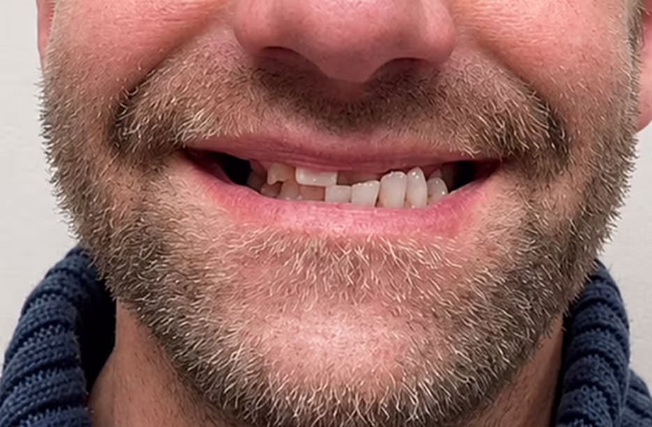 Ivan’s smile before treatment at Bell Road Dentistry