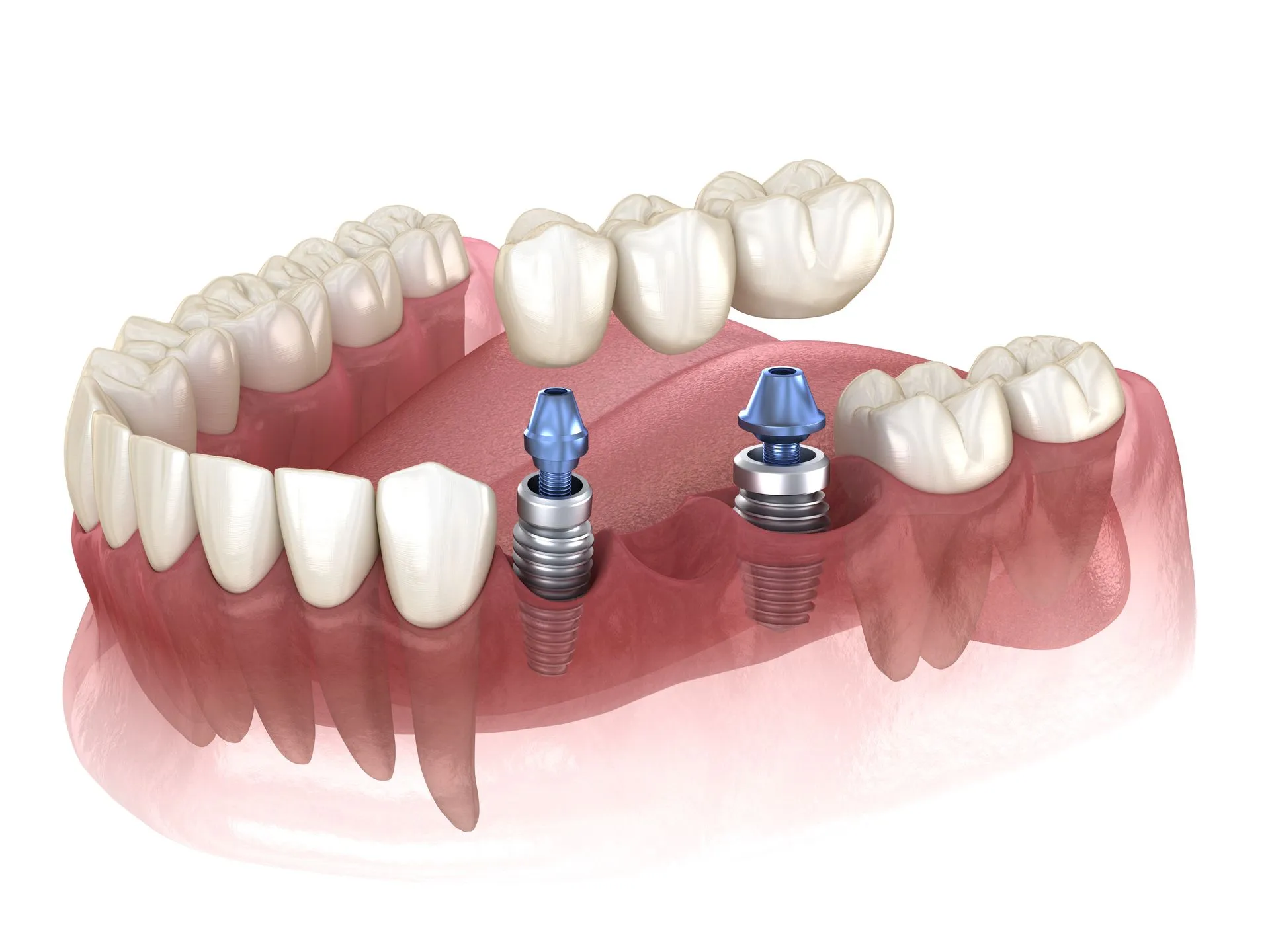 Dental implant restoration