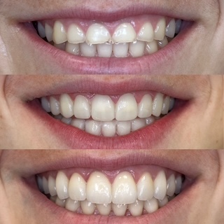 Kimbyl’s smile before treatment, with temporary restorations, and after crowns