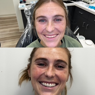 Before and after smile photos from a Bell Road Dentistry full-mouth reconstruction case
