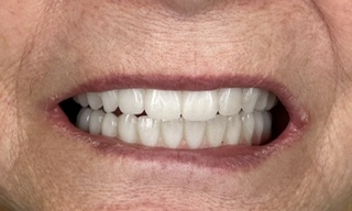 Linda after upper and lower full-arch treatment