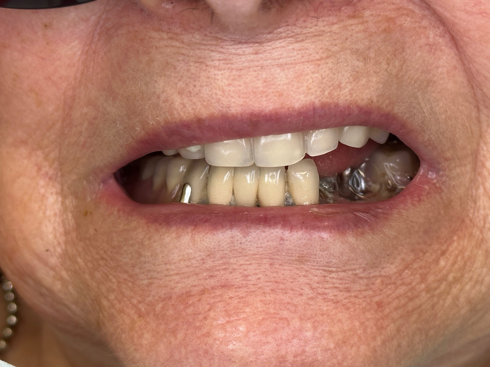 Linda before upper and lower full-arch treatment