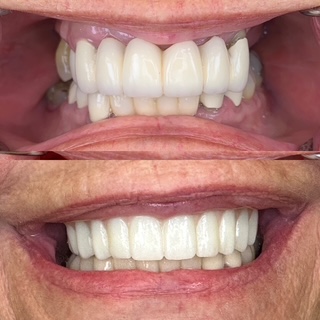 Missy before and after upper full-arch treatment