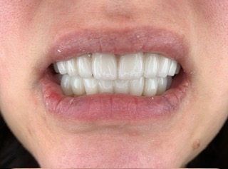 Rayla after full-mouth reconstruction