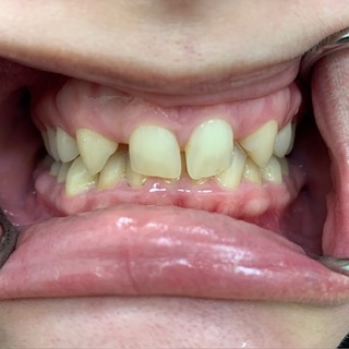 Rayla before full-mouth reconstruction