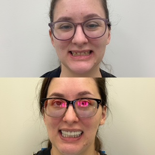 Rayla before and after full-mouth reconstruction smile photos