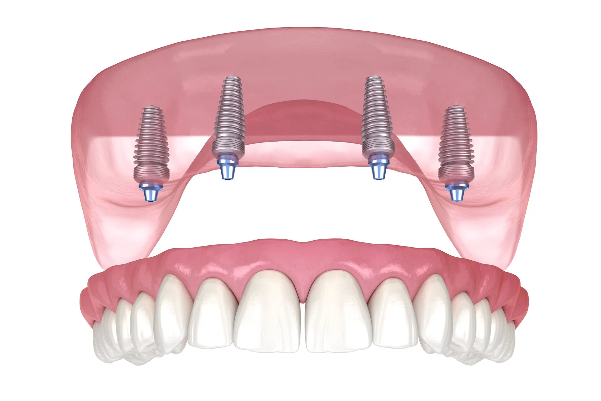 Dental implant restoration